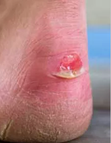 ROLLER DERBY BLISTERS!